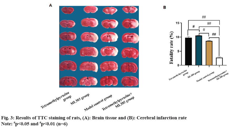 IJPS-infarction-rate