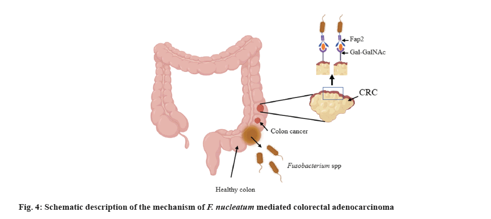 adenocarcinoma