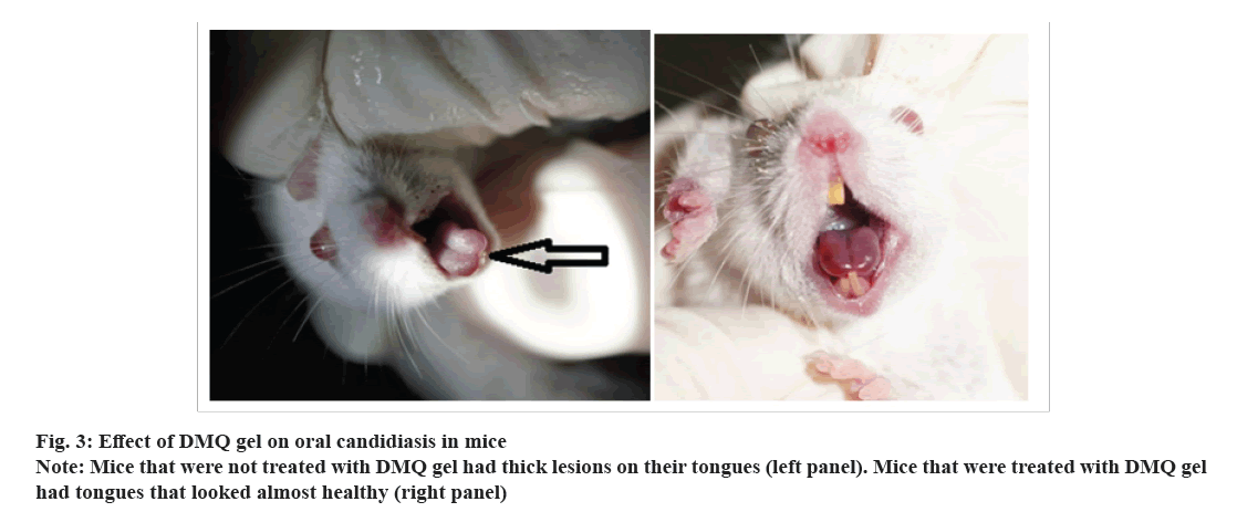 candidiasis