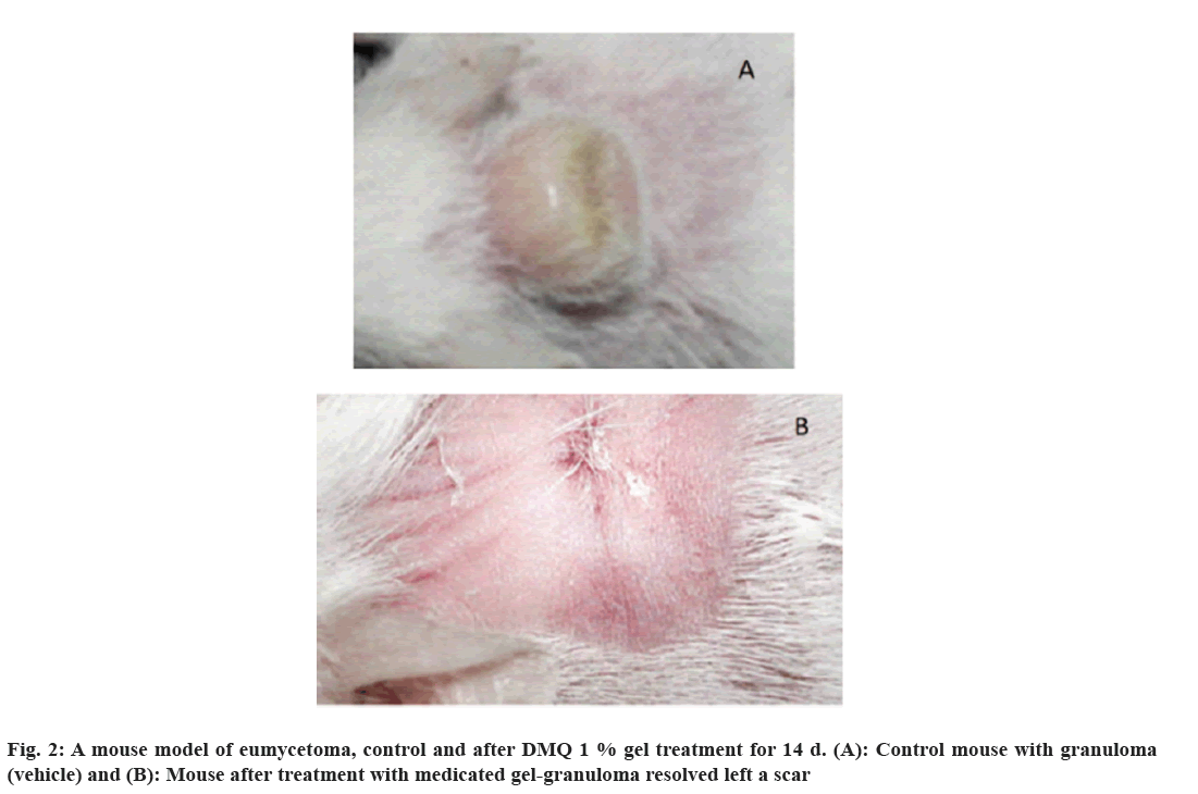 eumycetoma